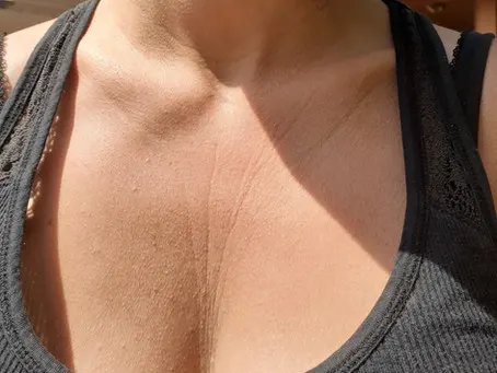 How I Finally Got Rid of Deep Lines & Wrinkles on My Chest & Neck