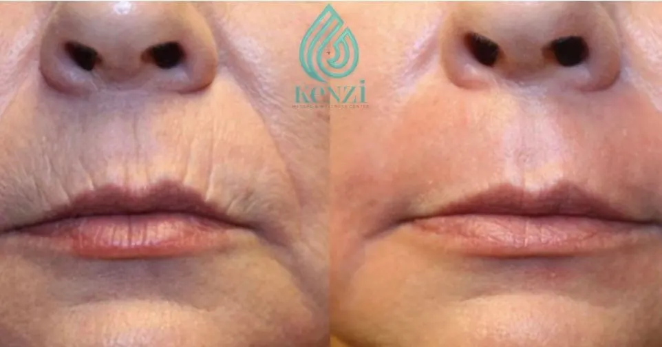 Before and After Photo of Plexr Soft Surgery