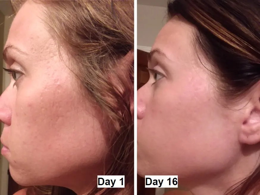 Skin Results After 16 Days Using Meladerm