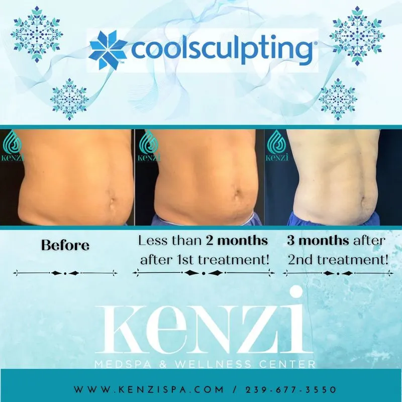 Before and After Results of CoolSculpting After 2 and 3 Months